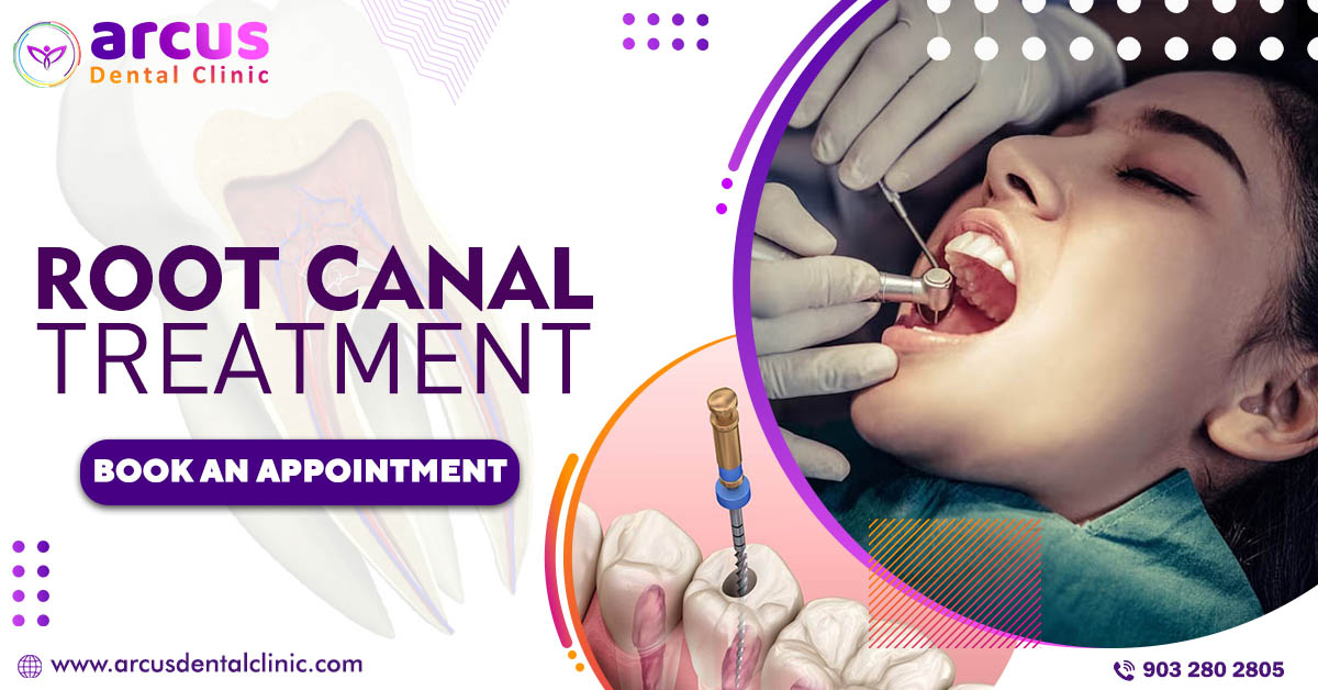 Benefits of Root Canal Treatment - Blog
