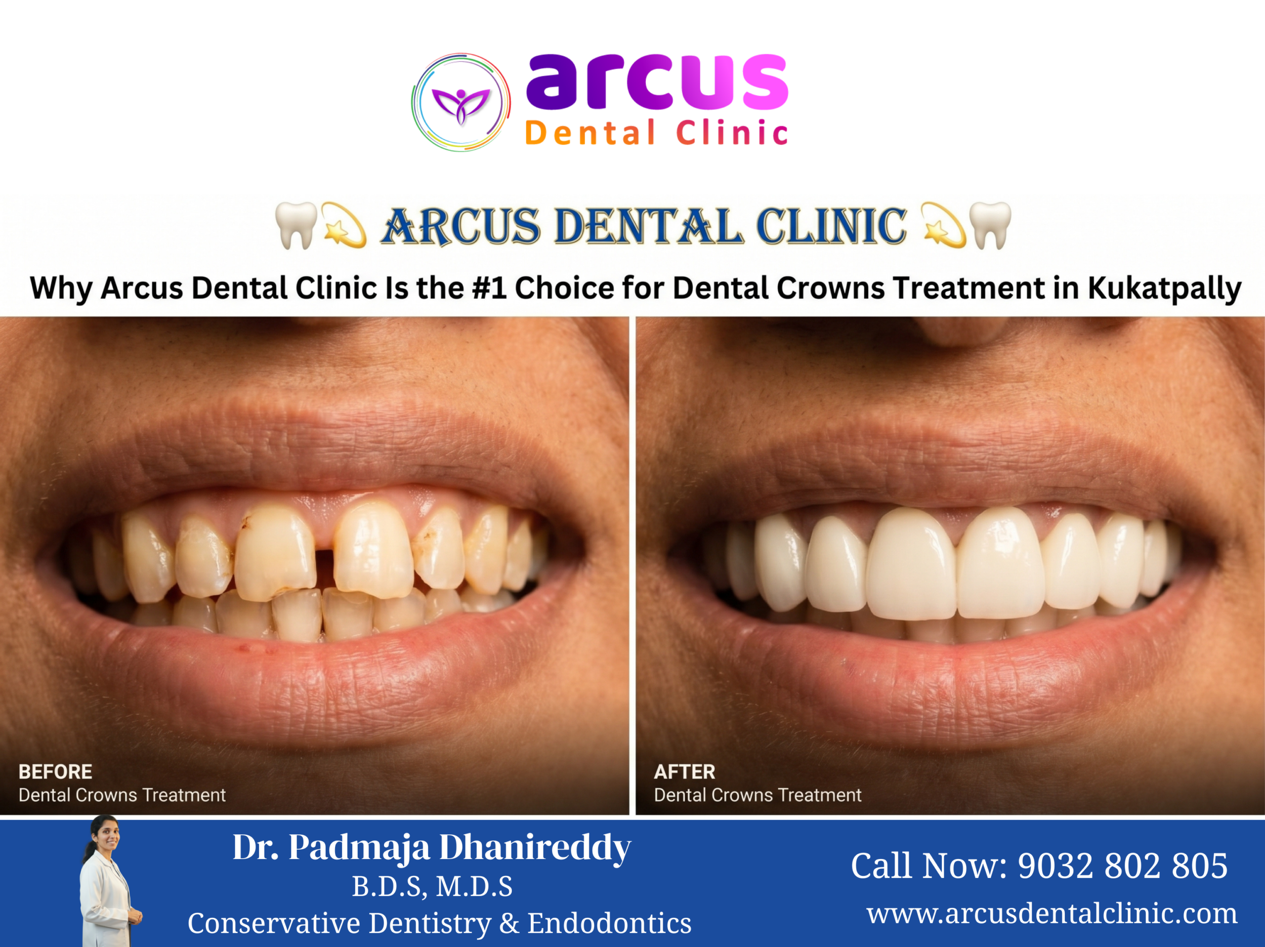 Dental Crowns Treatment Clinic In Kukatpally