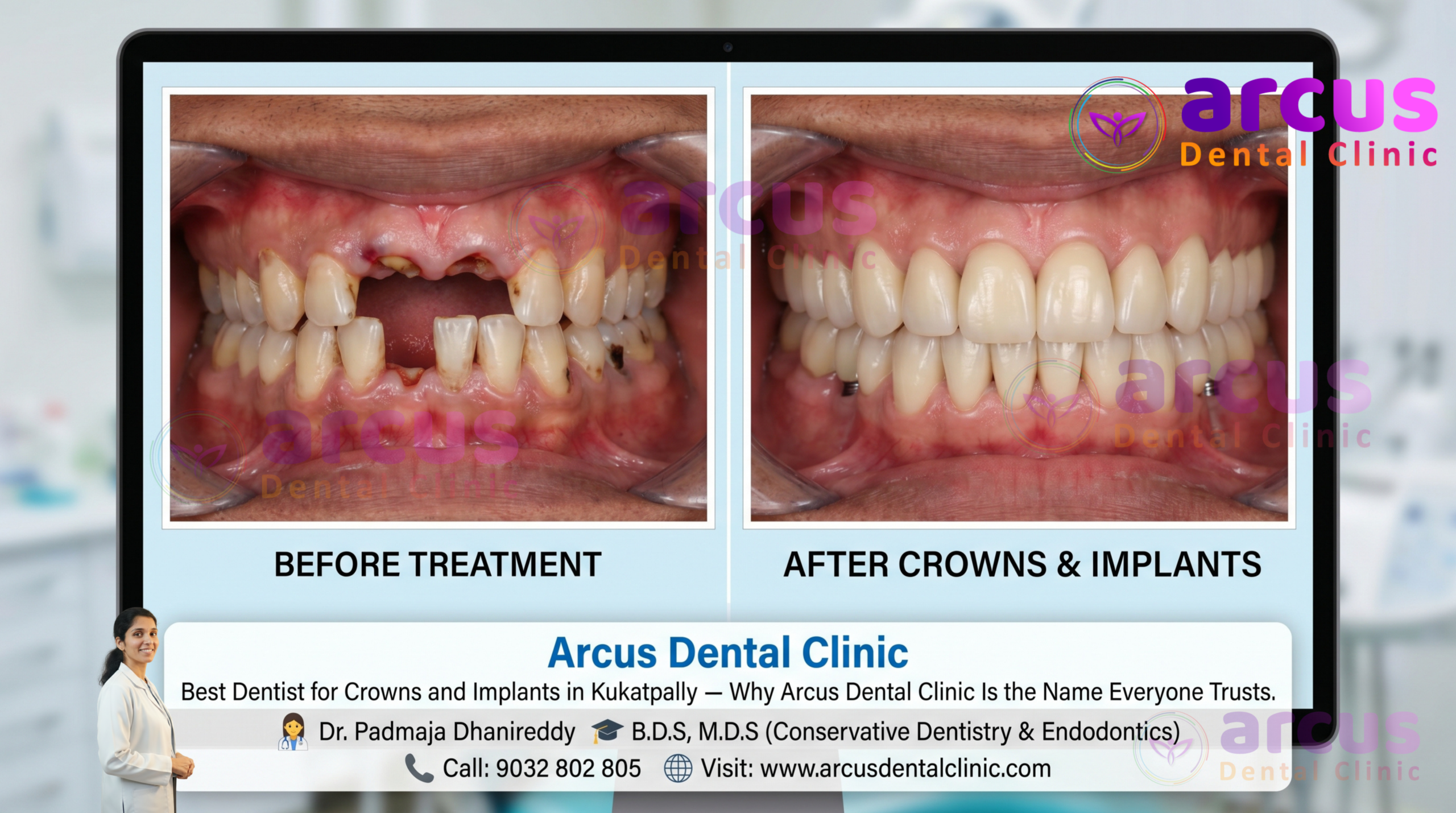 Best Clinic For Crowns And Implants In Kukatpally