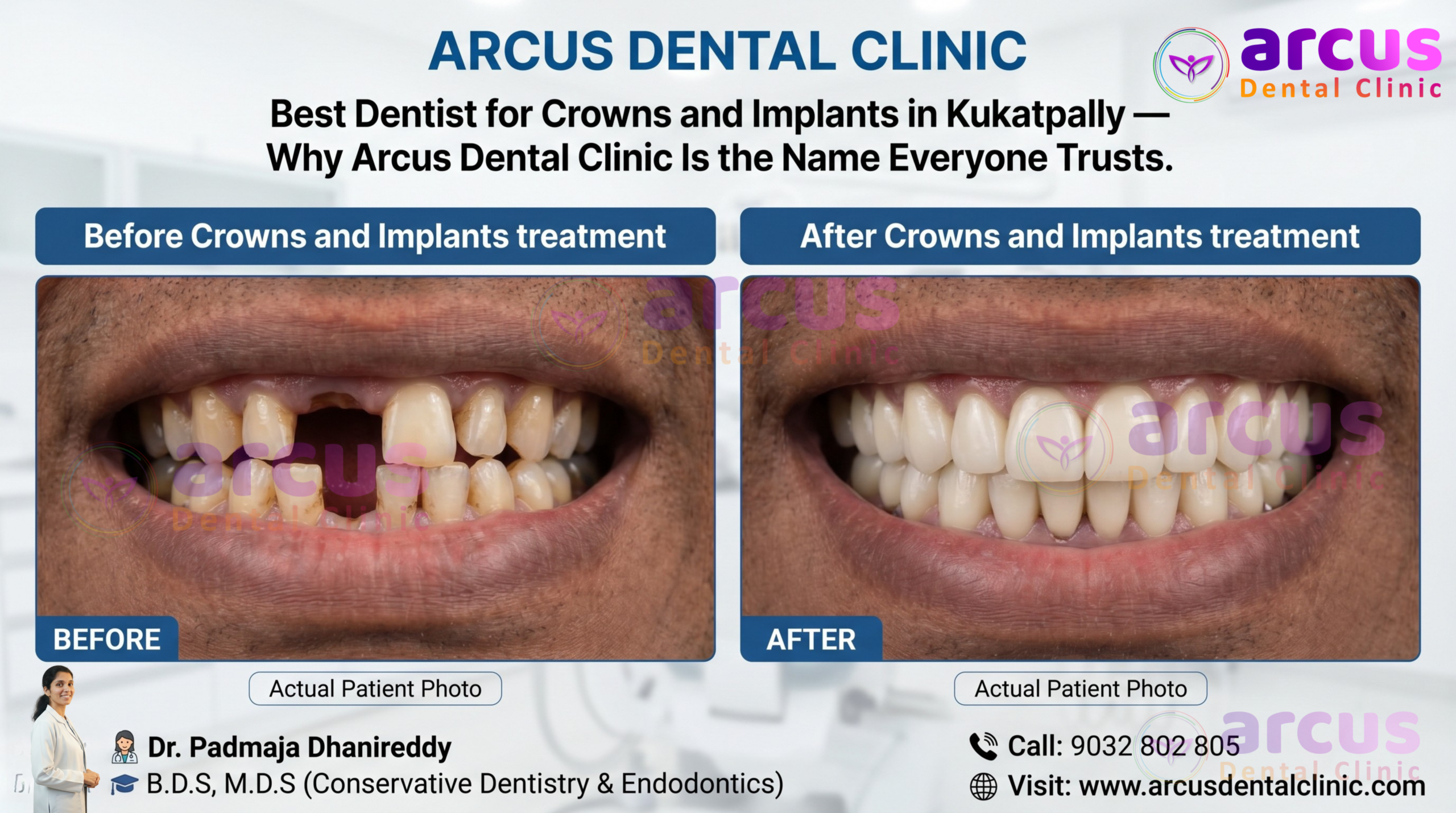 Best Dentist For Crowns and Implants In Kukatpally