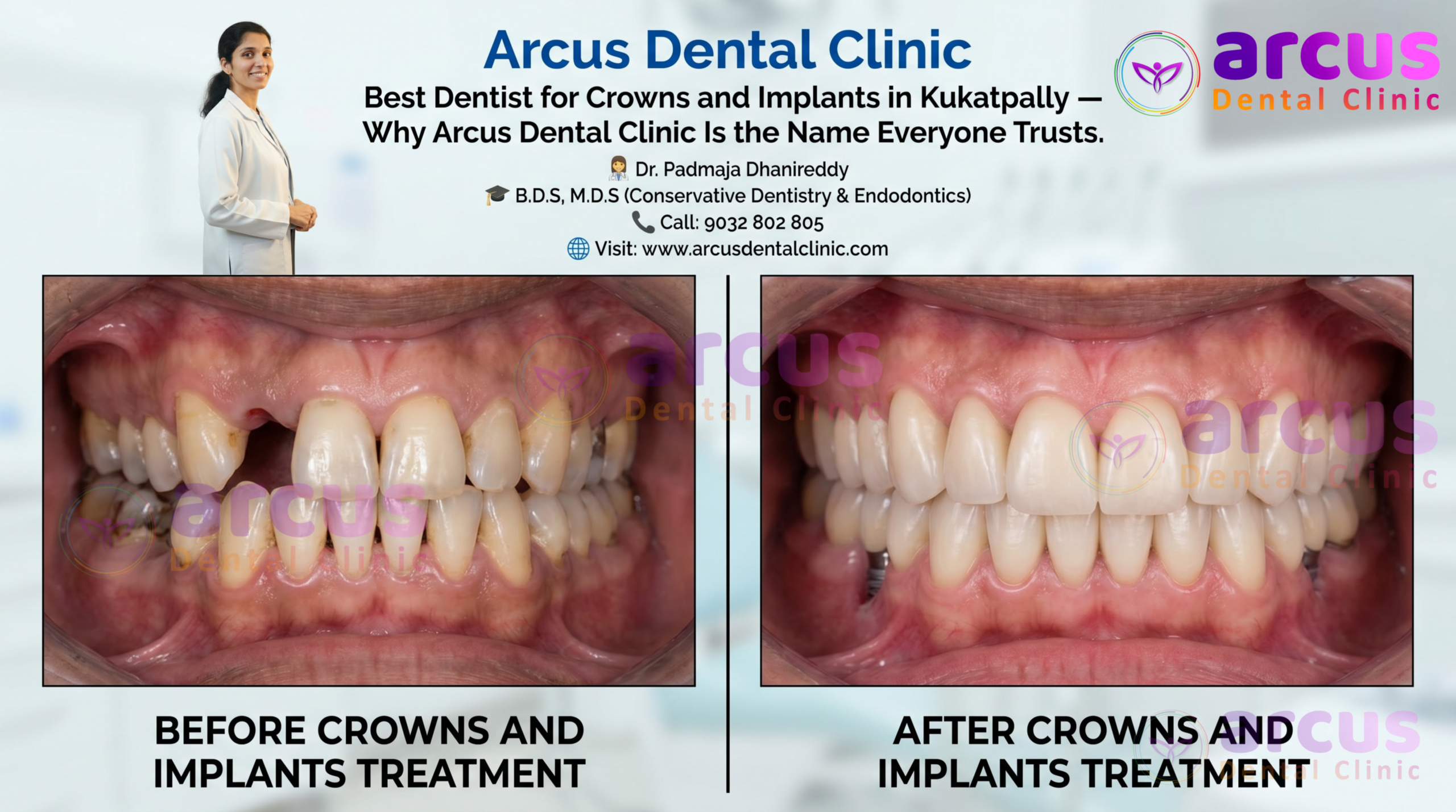 Best Dentist For Crowns and Implants In Kukatpally